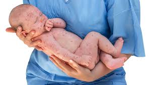 Herpes simplex, herpes simplex virus, hsv1, hsv2, human herpesvirus 1, hhv1, human herpesvirus 2, hhv2, infections due to hsv, cold sore, fever blister. Birth Acquired Herpes Causes Symptoms Picture And Prevention