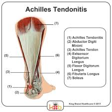 The achilles tendon joins the calf muscles to the heel bone and runs down the back of the lower leg. King Brand Ankle Images
