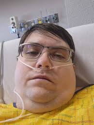 Gastric sleeve surgery recovery progress