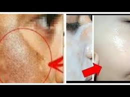 Cilt Lekelerini Acan Cildi Aydinlatan Muhtesem Dogal Maske Youtube 2020 Dogal Guzellik Ipuclari Maskeler Cil