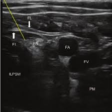 Ebraheim's educational animated video describes muscle anatomy of the thigh. Ultrasound Anatomy Of In Plane Femoral Nerve Block In The Upper Thigh Download Scientific Diagram