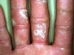 Peeling skin can occur as a reaction to a number of inflammatory processes of the skin or damage to the skin. Peeling Skin On Hands And Feet Causes And Skin Peeling Treatment
