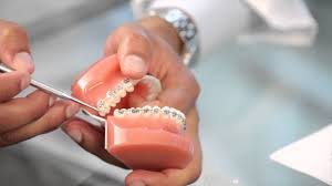 When this happens, read our 7 must know techniques to braces pain relief. Braces Broken Bracket Poking Wire Braces Pain Aura Orthodontics Youtube