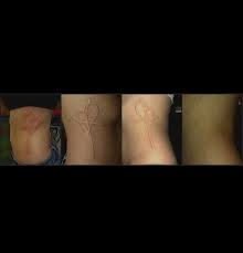 The Healing Process Of My White Ink Tattoo 1st Is The Day I Got It 2nd Is The Day After 3rd Is A Week After And 4th Is 3 White Ink