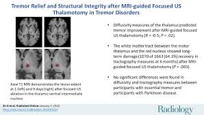 Image result for Thalamotomy