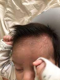 It can be due to over washing of the his or her scalp may lead to more revolting complications such as greasy hair and scalp. Cradle Cap Dry Scalp December 2019 Babies Forums What To Expect