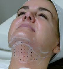 Cool Sculpting in Moncks Corner, SC