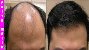 When one is ill or stressed out, hair fall, greying of hair, patches and breakouts on the scalp happen easily. Grow Long Hair 100 Natural Hair Loss Treatment Cure Baldness Remove Dandruff Thin Hair Hair Fall Youtube