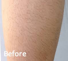Note that light blonde, white, gray, and red hair do not respond to the laser. Best Laser Hair Removal Technology In Knoxville Tn Revitalyze Md