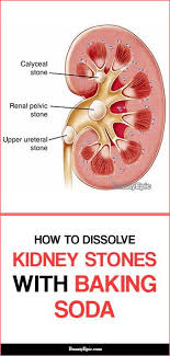 How To Dissolve Kidney Stones Quickly With Baking Soda Kidney Stones Kidney Baking Soda