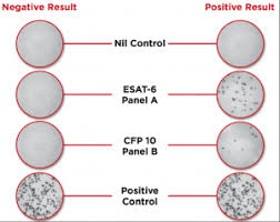 interpreting tuberculosis test results with the t spot tb