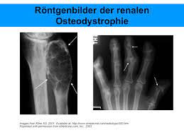 Die renale osteopathie ist mit einer notwendigen. Ckd Mbd Beinharte Knochengrundlagen Ppt Video Online Herunterladen