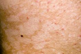 It slowly dissolves and treats the infection in a day or two, but the medication itself. Fungal Skin Infections Symptoms And Treatments Bupa Uk