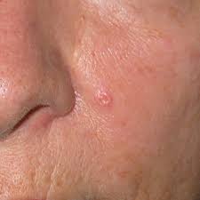 Die kleienpilzflechte ist eine hautmykose, also eine pilzerkrankung der haut. Dermatologie Dermatologie Dr Fritsch Dusseldorf