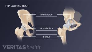 Image result for Hip Labral Tear