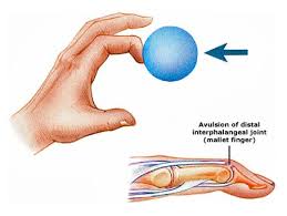 Surgical treatment of mallet finger fractures by tension band technique. Mallet Finger Causes Symptoms Treatment How To Relief