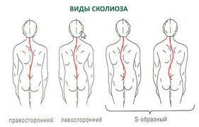انواع و درجات الجنف بالصور المرسال