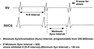 Image result for Synchronized Cardioversion