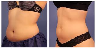 Coolsculpting before and after pics on the thighs show how effectively coolsculpting reduces inner thigh fat and outer thigh fat (commonly known as saddle bags.) coolsculpting the thighs is especially popular among women who often struggle with stubborn fat deposits that cling to the thighs.* Coolsculpting Abdomen Treatments Learn How Coolsculpting Belly Fat Reduction Can Help You Element Body Lab