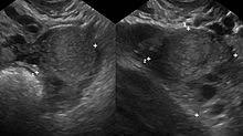 Bei endometriose treten herde aus gewebe, das gebärmutterschleimhaut sehr ähnlich ist (ähnlich aber nicht gleich), an anderen stellen im körper auf. Endometriose Wikipedia
