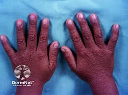 Image result for Papular Acrodermatitis