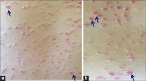 Image result for Auspitz Sign