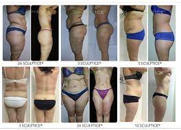 Pictures are 1 year apart. Sculptice Body And Face Sculpting The Angels Touch