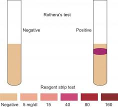 tests for detection of ketones in urine