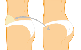 This procedure takes fat from one area of your body and places it in the buttocks, resulting in a curvier, sexier buttock. Brazilian Butt Lift Mit Fetttransfer Zu Povergrosserung Und Sanduhrfigur Lipocenter