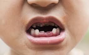 Tooth Decay Dental Cavity Dental Cavities Tooth Decay Dental Health
