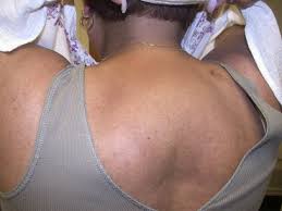 Hump on back of neck (pic)? Buffalo Hump In Hiv Patients Surgical Management With Liposuction Sciencedirect
