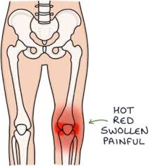 Image result for Septic Joint