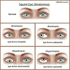 Strabismus Misaligned Eyes Double Vision Nursing Assessment Top Nursing Schools Nursing School