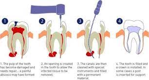 The Bitter Truth About Root Canals Root Canal Treatment Root Canal Dental Care