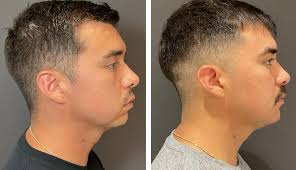 Image result for Micrognathia