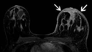 Indications for breast mri in the patient with newly diagnosed breast cancer. Inflammatory Breast Cancer The Disease The Biology The Treatment Robertson 2010 Ca A Cancer Journal For Clinicians Wiley Online Library