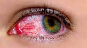 But now, one particular eye symptom connected to covid has doctors on alert. Covid 19 And Conjunctivitis Visionaire Eye Consultants Ophthalmologists