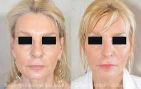 Aug 15, 2018 · average age of rhinoplasty patient in my experience, most people seeing a rhinoplasty are between young and middle adulthood (ie 20 to 50's). Rhinoplasty Before After Photos Beverly Hills La Rhinoplasty