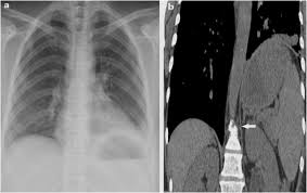 Shrinking Lung Syndrome Caused By Systemic Lupus Erythematosus A Case Report Springerlink