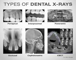 Types Of Dental X Rays Dental Hygiene School Dental Dental Hygiene Student