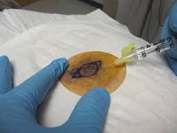 Image result for Local Skin Anesthesia