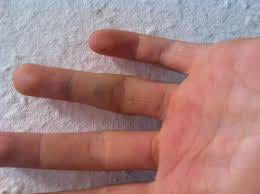 Find out how to tell if you have a broken finger or thumb, what you should do, and how long it takes to heal. Gebrochen Aber Kein Gips Schmerzen Finger