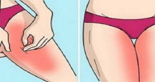 Inner thigh rashes are quite common and don't relate to any health concerns. Rash On Inner Thigh Inner Thigh Rash Rashes Remedies Heat Rash