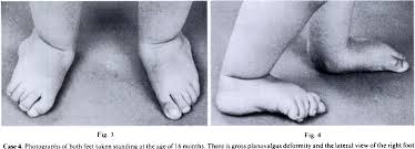 Treatment is usually ponseti method casting. Pdf Reverse Club Foot Rigid And Recalcitrant Talipes Calcaneovalgus Semantic Scholar