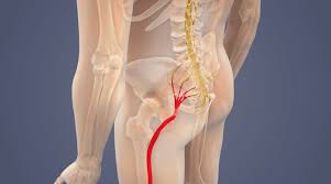 Image result for Sciatica
