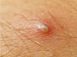 Removing the hair can be challenging and painful and isn't always successful. Ingrown Hairs How To Spot And Remove Them