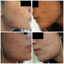 Hier kann vitamin c mehr schaden anrichten, als es dir helfen wird. Ist Meine Akne Schlimm Soll Ich Zum Ha Gesundheit Und Medizin Gesundheit Beauty
