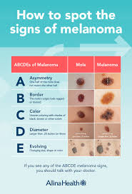 The third letter c stands for color. Melanoma And Your Moles Know What S New