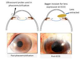 Image result for Cataract Extraction
