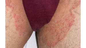 Image result for Intertrigo under breasts